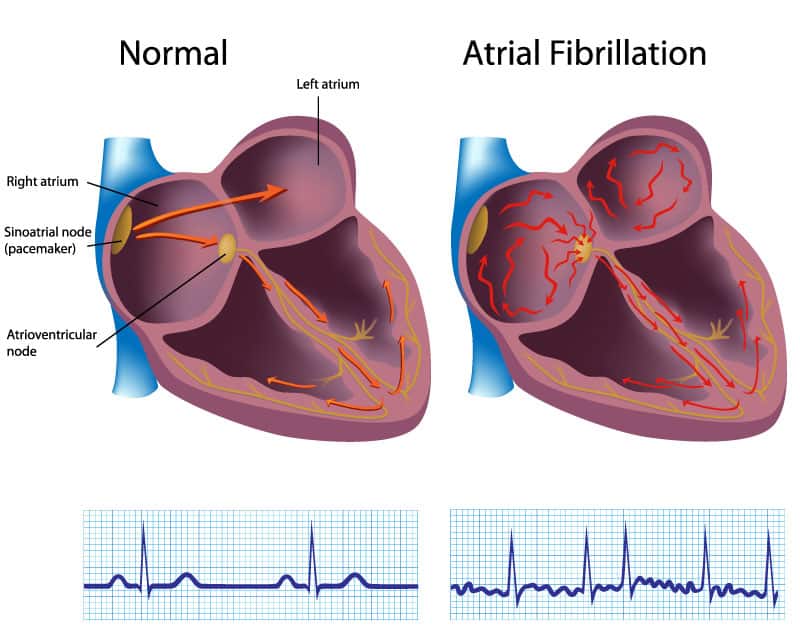 heart diagram demonstrating normal heart vs atrial fibrillation